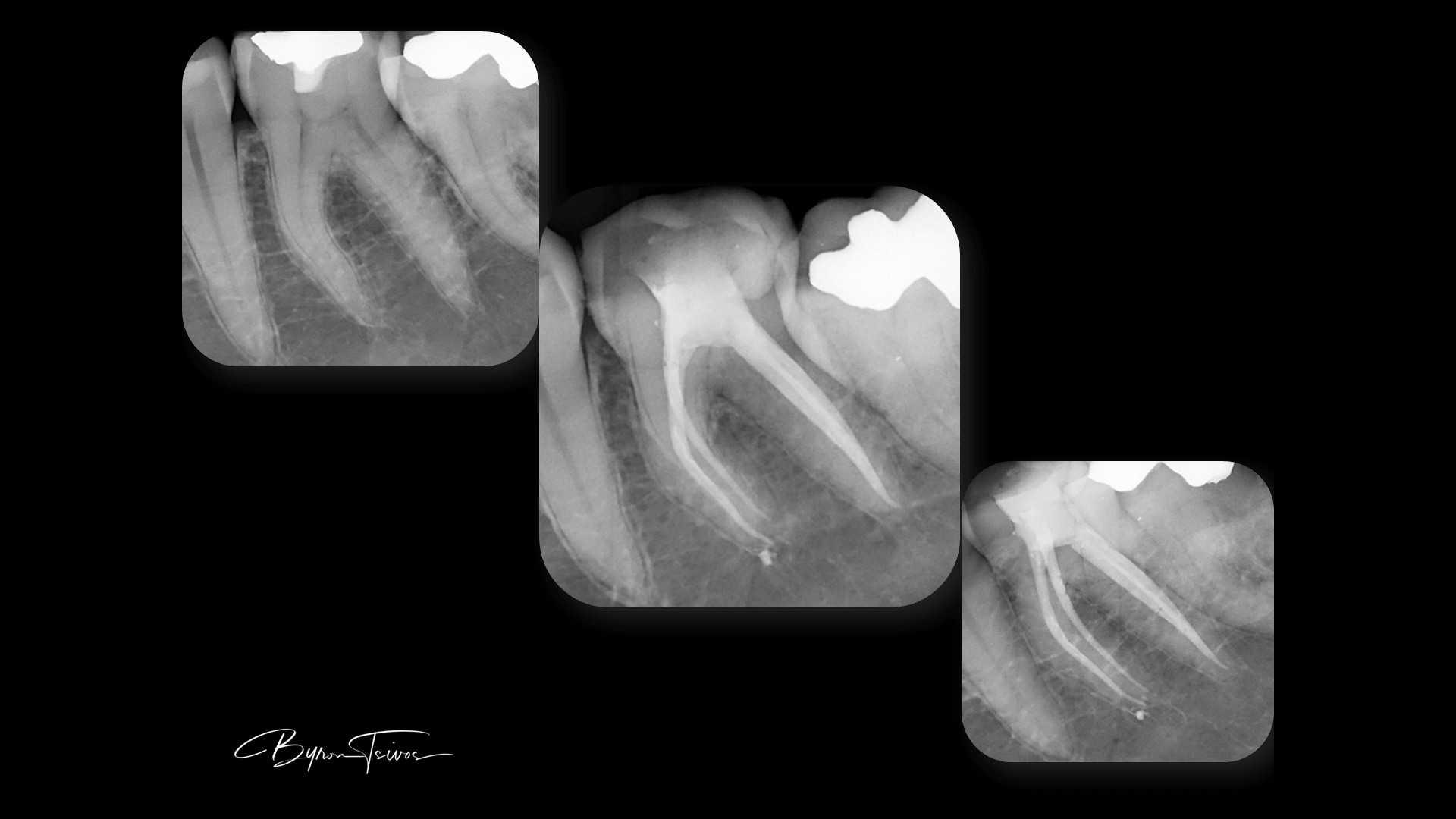 Broken Instrument Removal - Case 6
